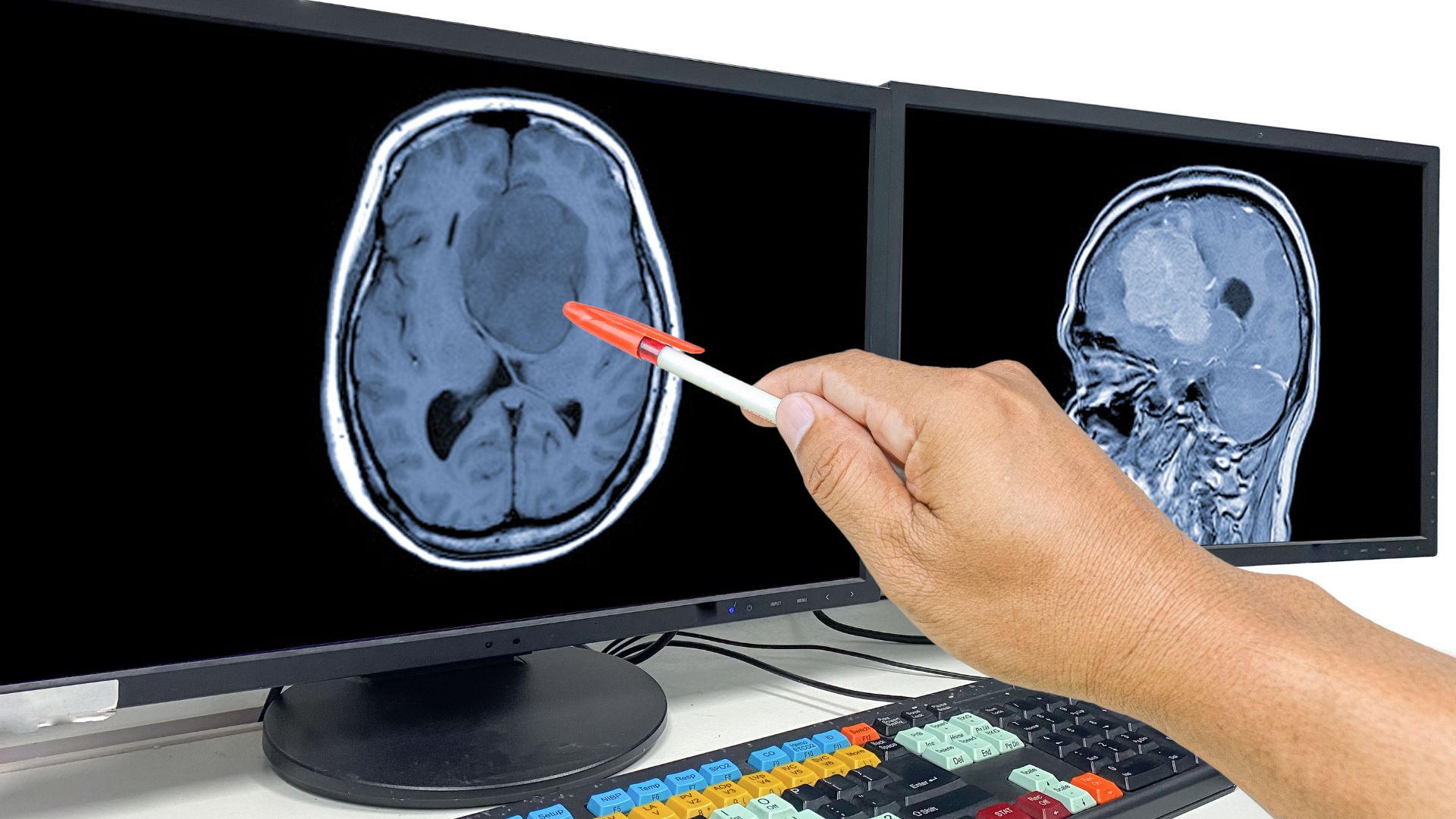 πολύμορφο γλοιοβλάστωμα glioblastoma multiforme